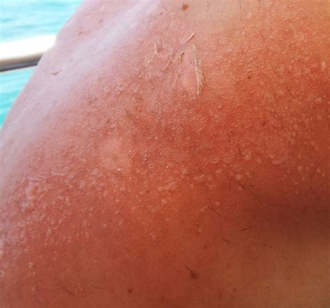 These Signs Indicate A Serious Sunburn That Requires Medical Attention
