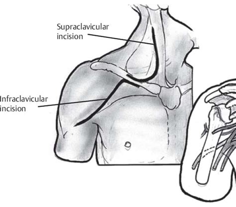 Supraclavicular And Infraclavicular Brachial Plexus Exposure And