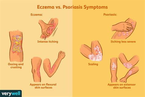Eczema Vs Psoriasis How To Tell Them Apart