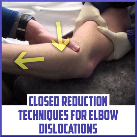 Closed Reduction Techniques For Elbow Dislocations Sports Medicine Review