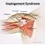 Impingement Syndrome Treatment Exercise Home Remedies