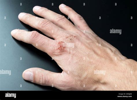 Chapped Hands From Cold Weather Dry Cracked Knuckles Stock Photo Alamy