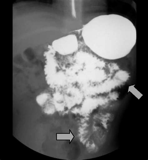 Primary Intestinal Lymphangiectasia Twenty Years Of Experience At A