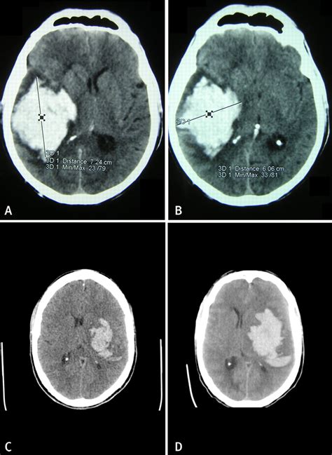 Spontaneous Intracerebral Haemorrhage The Bmj