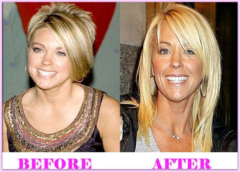 Kate Gosselin Plastic Surgery Controversy Plastic Surgery Before And