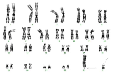 A Karyotype Of The 4 Th Patient With X Chromosome Showing Fragile Site Download Scientific