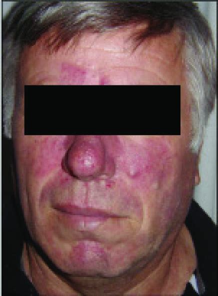 Rosacea Like Tinea Faciei Download Scientific Diagram