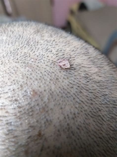 Is This A Wart Located At The Top Head Scalp More Pictures Provided