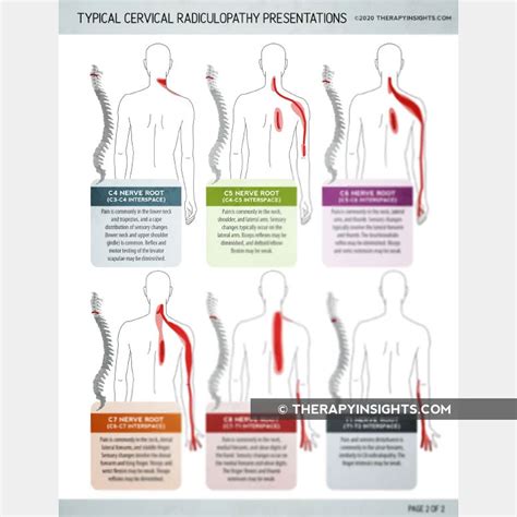 Typical Cervical Radiculopathy Presentations Printable Handouts For
