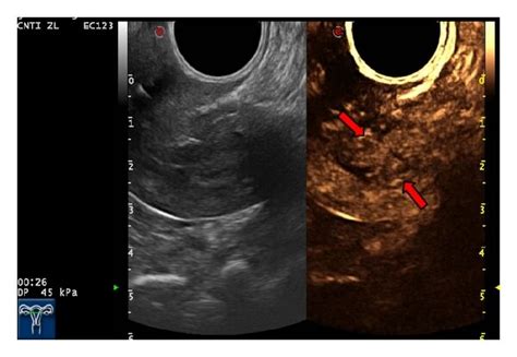 Endometrial Hyperplasia And Myoma Of Uterus Misdiagnosed As Stage Ib