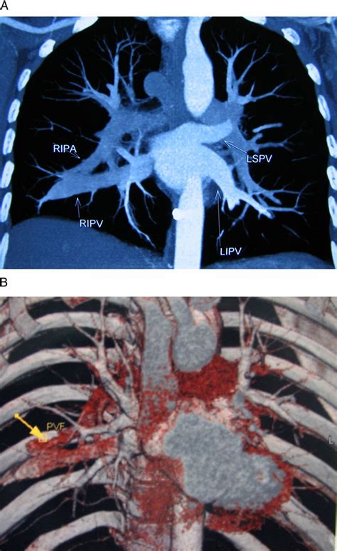 Traumatic Pulmonary Arteriovenous Fistula May Be Misdiagnosed With