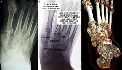 Lisfranc Injuries A Matter Of Ligament Disruption The Journal Of