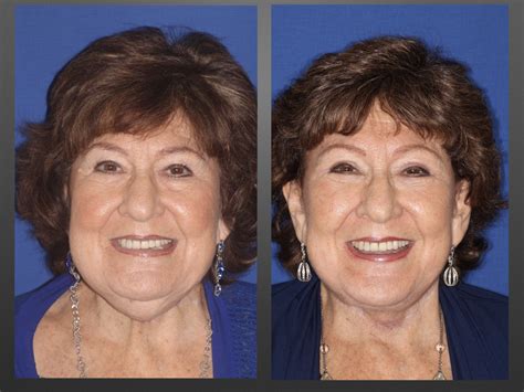 Featured Facial Rejuvenation 1 Newport News Va The Aesthetic Face