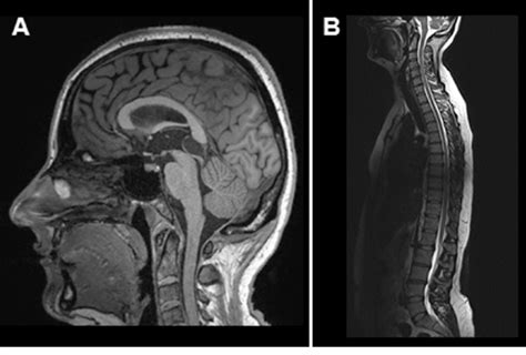 A A Large Pineal Cyst With Compressed Quadrigeminal Plate And Download Scientific Diagram