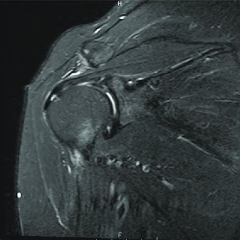 Coronal Mri Image Of An Articular Sided Partialthickness Tear Of The