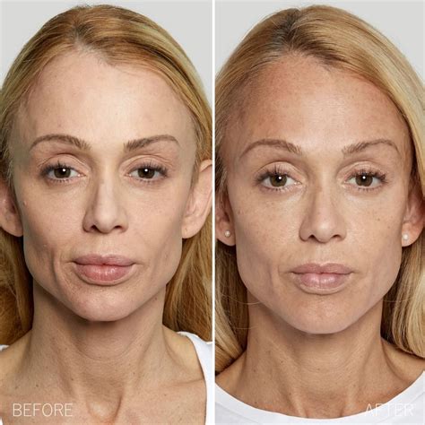 revive at the group › sculptra