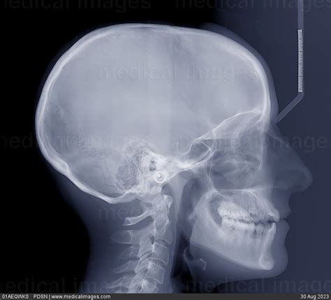 Stock Image X Ray Of The Skull Side View Showing The Normal Teeth And