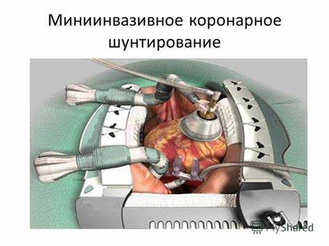 Презентация на тему: "Лечение ИБС. АКШ. МКШ. шунтирование". Скачать Картинка - Презентация на тему: "Лечение ИБС. АКШ. МКШ. шунтирование". Скачать