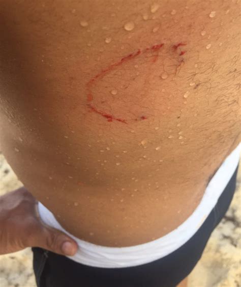 Man Bitten By Shark In Miami