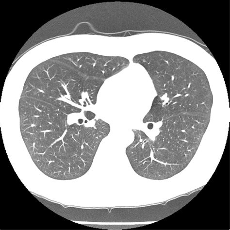 Abnormal Chest Ct Scan