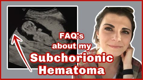 Everything To Know About A Subchorionic Hemorrhage In Pregnancy Youtube