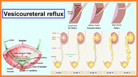 vesicoureteral reflux youtube