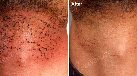 Brazilian Laser Hair Removal Side Effects Effect Choices