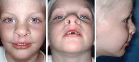 Repair Of Bilateral Cleft Lip And Nasal Deformity Pla