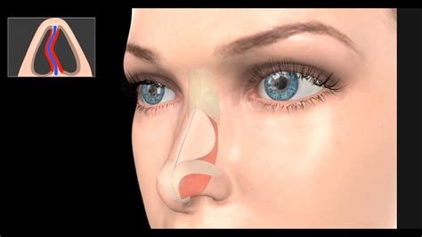 Deviated Septum Surgery Septoplasty Youtube