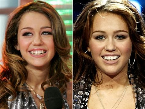 Celebrity Teeth Before And After Veneers Traceybell