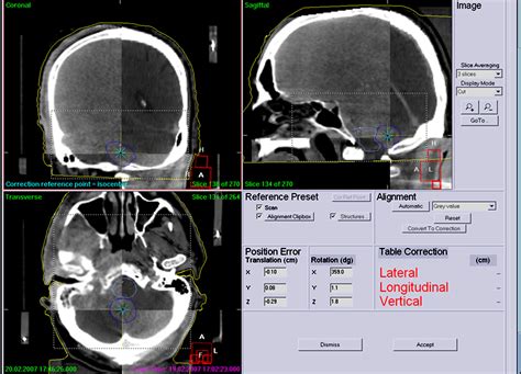 Cone Beam Ct Image Guidance For Intracranial Stereotactic Treatments