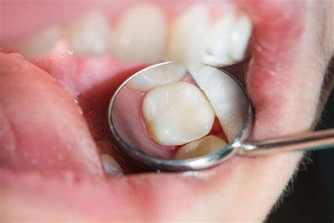 Cavityandbroken Tooth — Hall Dental