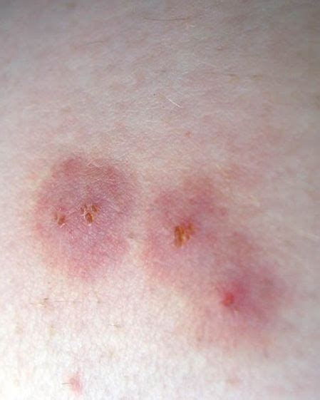 19 Common Bug Bite Pictures How To Id Insect Bites And Stings