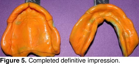 Elastomeric Impression Technique For Complete Denture Impressions