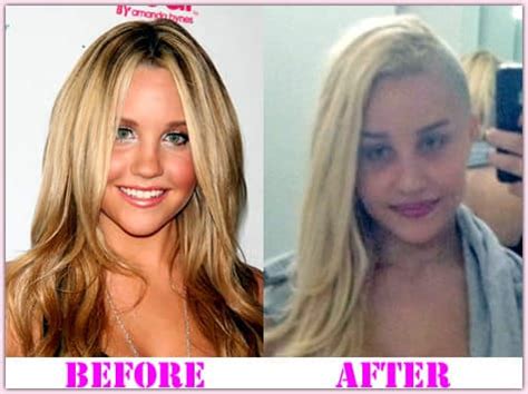 Amanda Bynes Before And After Plastic Surgery