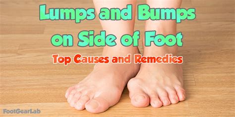 Lumps And Bumps On Side Of Foot Top Causes And Remedies