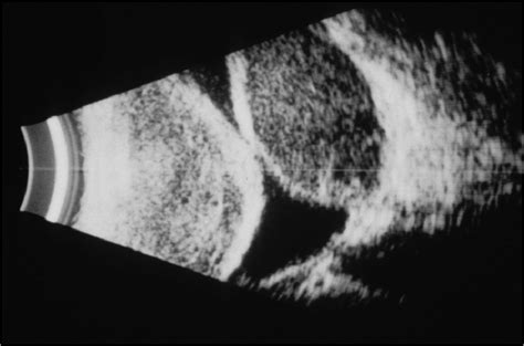 B Scan Echography Demonstrating An Example Of Appositional