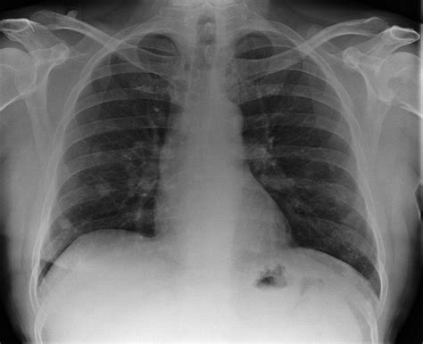 Multiple Pulmonary Nodules In A Male With Psoriatic Arthritis