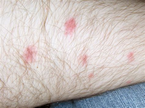 Red Dots On Legs Bumps After Shaving Legs Pubes Down There Face