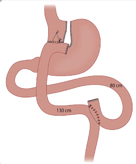 Illustration Of The Roux En Y Gastric Bypass Technique Download Scientific Diagram