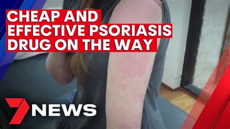 New And Cheap Psoriasis Treatment On The Way For Australians NEWS YouTube