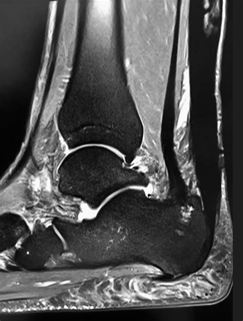 Achilles Tendonitis Achilles Tendinopathy Surgery David Redfern