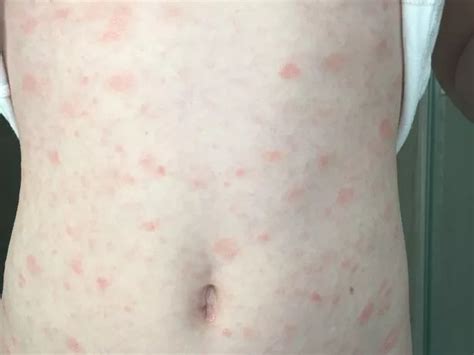 Experts Show Images Of Eight Rash Types That Could Be Covid Symptom