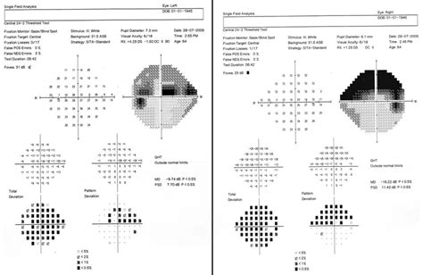 Humphrey Visual Fields Of The Patient Download Scientific Diagram