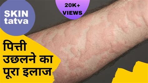 This is an allergic reaction. URTICARIA TREATMENT IN HINDI || SKIN ALLERGY TREATMENT ...