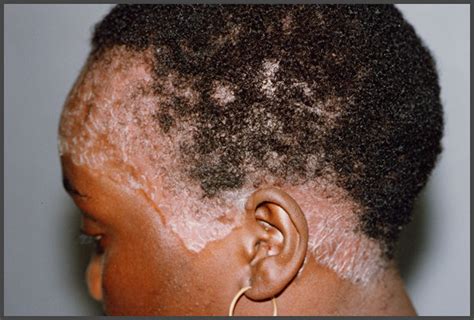Psoriasis Pictures African American Skin Psoriasis Expert
