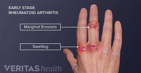 Hand Rheumatoid Arthritis Ra Signs And Symptoms