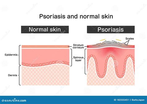 Cross Section Of Psoriasis And Normal Skin Flat Vector Illustration