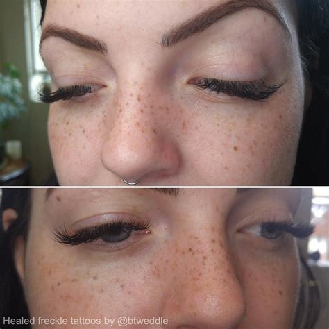 Healed Tattooed Freckles Mingling Happily With Natural Ones We Added A