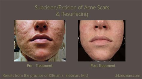 Acne Laser Scar Removal Before And After
